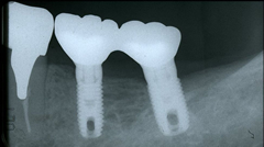 インプラント治療後