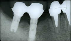 インプラント治療後