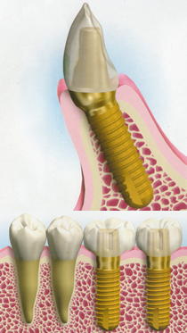 インプラント写真