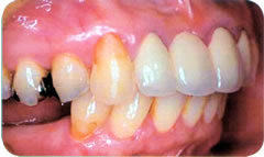 インプラント治療前