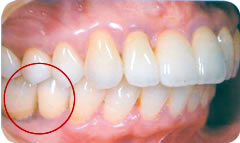 インプラント治療後